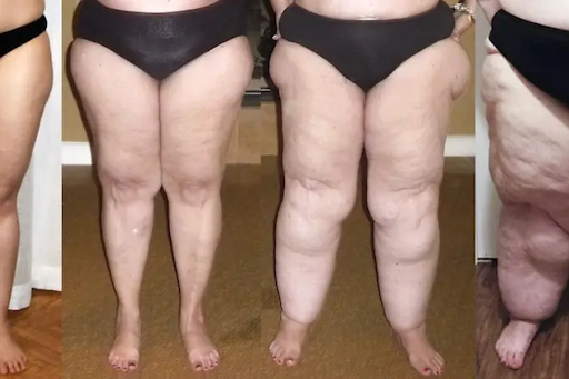 celebrities with lipedema